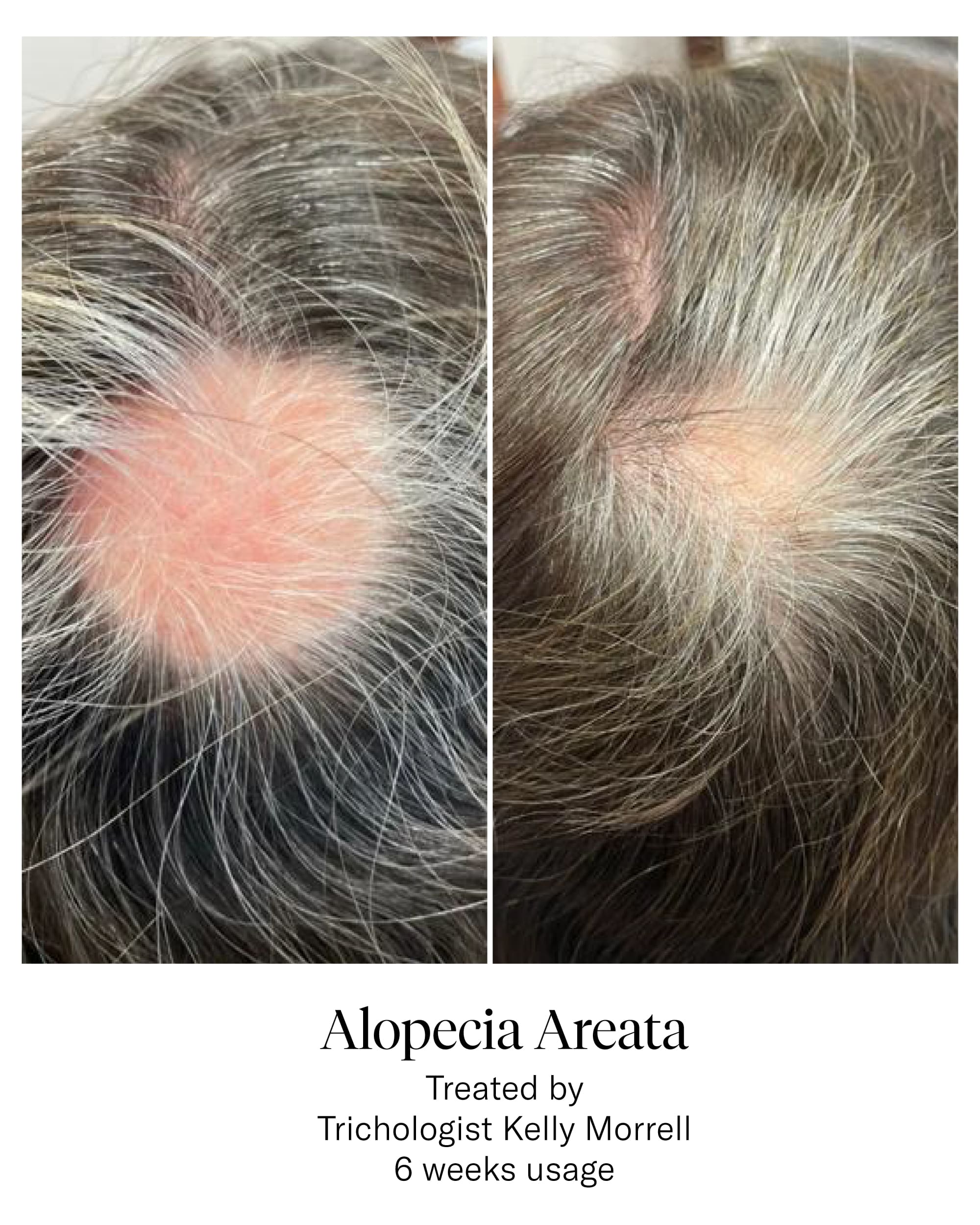 Advanced Hair System